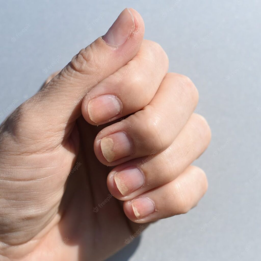 onycholysis of the nail